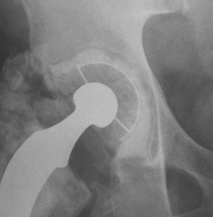 Revision Acetabulum Paprosky Type IIA